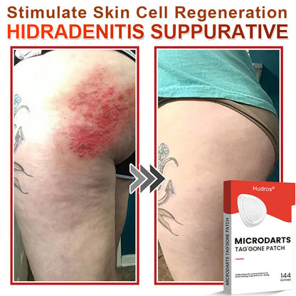 👩🏼‍⚕️ Hudros® 2-in-1 Microneedle & Hydrocolloid Patch | Raised Moles,Acne,  Flat Warts & Skin Tags Remover | Improves Wrinkles, Scars & Blemishes | Invisible Star Pimple Patches for Face & Body | 144 Count