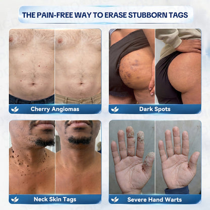 𝐏𝐡𝐚𝐫𝐦𝐚𝐜𝐢𝐬𝐭 𝐑𝐞𝐜𝐨𝐦𝐦𝐞𝐧𝐝𝐞𝐝🥇𝐏𝐢𝐜𝐝𝐨® 7-𝐃𝐚𝐲 𝐒𝐤𝐢𝐧 𝐓𝐚𝐠 & 𝐒𝐩𝐨𝐭 𝐄𝐫𝐚𝐬𝐞𝐫 𝐂𝐫𝐞𝐚𝐦 🍀(Zero Pain, Zero 𝐒𝐜𝐚𝐫𝐬 Formula)