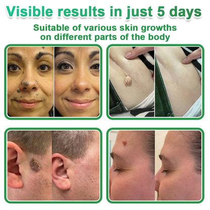 📌Hudros® 2-in-1 Microneedle & Hydrocolloid Patch | Raised Moles,Acne,  Flat Warts & Skin Tags Remover | Improves Wrinkles, Scars & Blemishes | Invisible Star Pimple Patches for Face & Body | 144 Count