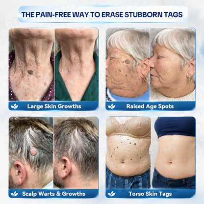 𝐏𝐡𝐚𝐫𝐦𝐚𝐜𝐢𝐬𝐭 𝐑𝐞𝐜𝐨𝐦𝐦𝐞𝐧𝐝𝐞𝐝🥇𝐏𝐢𝐜𝐝𝐨® 7-𝐃𝐚𝐲 𝐒𝐤𝐢𝐧 𝐓𝐚𝐠 & 𝐒𝐩𝐨𝐭 𝐄𝐫𝐚𝐬𝐞𝐫 𝐂𝐫𝐞𝐚𝐦 🍀(Zero Pain, Zero 𝐒𝐜𝐚𝐫𝐬 Formula)
