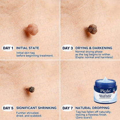 𝐏𝐡𝐚𝐫𝐦𝐚𝐜𝐢𝐬𝐭 𝐑𝐞𝐜𝐨𝐦𝐦𝐞𝐧𝐝𝐞𝐝🥇𝐏𝐢𝐜𝐝𝐨® 7-𝐃𝐚𝐲 𝐒𝐤𝐢𝐧 𝐓𝐚𝐠 & 𝐒𝐩𝐨𝐭 𝐄𝐫𝐚𝐬𝐞𝐫 𝐂𝐫𝐞𝐚𝐦 🍀(Zero Pain, Zero 𝐒𝐜𝐚𝐫𝐬 Formula)