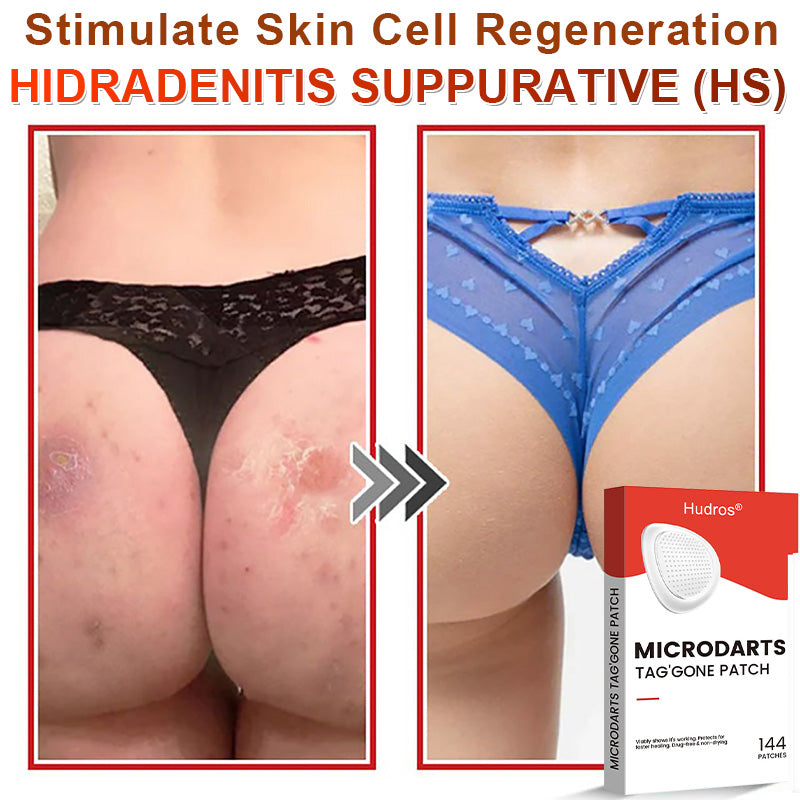 👩🏼‍⚕️ Hudros® 2-in-1 Microneedle & Hydrocolloid Patch | Raised Moles,Acne,  Flat Warts & Skin Tags Remover | Improves Wrinkles, Scars & Blemishes | Invisible Star Pimple Patches for Face & Body | 144 Count