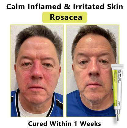 【 𝐿𝑚𝑖𝑝𝑘𝑖®Official Store✅】𝙇𝙢𝑖𝑝𝙠𝙞® Derma  Repair Cream (𝗔𝗽𝗽𝗹𝘆 𝘁𝘄𝗶𝗰𝗲 𝗱𝗮𝗶𝗹𝘆, 𝘄𝗮𝗿𝘁-𝗳𝗿𝗲𝗲 𝗿𝗲𝘀𝘂𝗹𝘁𝘀 𝗶𝗻 𝟮–𝟯 𝘄𝗲𝗲𝗸𝘀) ✅ 𝐅𝐨𝐫 𝒔𝒌𝒊𝒏 𝒕𝒂𝒈, 𝒘𝒓𝒊𝒏𝒌𝒍𝒆𝒔, 𝒗𝒊𝒕𝒊𝒍𝒊𝒈𝒐, 𝒓𝒐𝒔𝒂𝒄𝒆𝒔, 𝒆𝒄𝒛𝒎𝒂, 𝒖𝒓𝒕𝒊𝒄𝒂𝒓𝒊𝒂, 𝒅𝒓𝒚 𝒂𝒏𝒅 𝒇𝒍𝒂𝒌𝒚, 𝐚𝐧𝐝 𝐦𝐨𝐫𝐞
