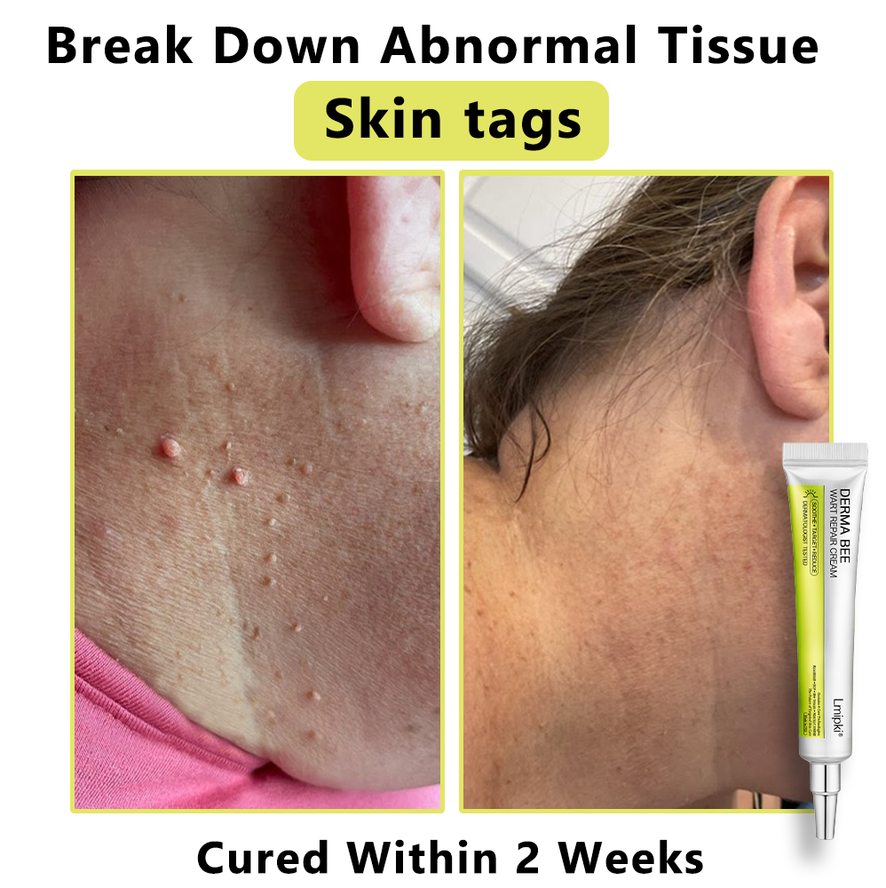 【 𝐿𝑚𝑖𝑝𝑘𝑖®Official Store✅】𝙇𝙢𝑖𝑝𝙠𝙞® Derma  Repair Cream (𝗔𝗽𝗽𝗹𝘆 𝘁𝘄𝗶𝗰𝗲 𝗱𝗮𝗶𝗹𝘆, 𝘄𝗮𝗿𝘁-𝗳𝗿𝗲𝗲 𝗿𝗲𝘀𝘂𝗹𝘁𝘀 𝗶𝗻 𝟮–𝟯 𝘄𝗲𝗲𝗸𝘀) ✅ 𝐅𝐨𝐫 𝒔𝒌𝒊𝒏 𝒕𝒂𝒈, 𝒘𝒓𝒊𝒏𝒌𝒍𝒆𝒔, 𝒗𝒊𝒕𝒊𝒍𝒊𝒈𝒐, 𝒓𝒐𝒔𝒂𝒄𝒆𝒔, 𝒆𝒄𝒛𝒎𝒂, 𝒖𝒓𝒕𝒊𝒄𝒂𝒓𝒊𝒂, 𝒅𝒓𝒚 𝒂𝒏𝒅 𝒇𝒍𝒂𝒌𝒚, 𝐚𝐧𝐝 𝐦𝐨𝐫𝐞