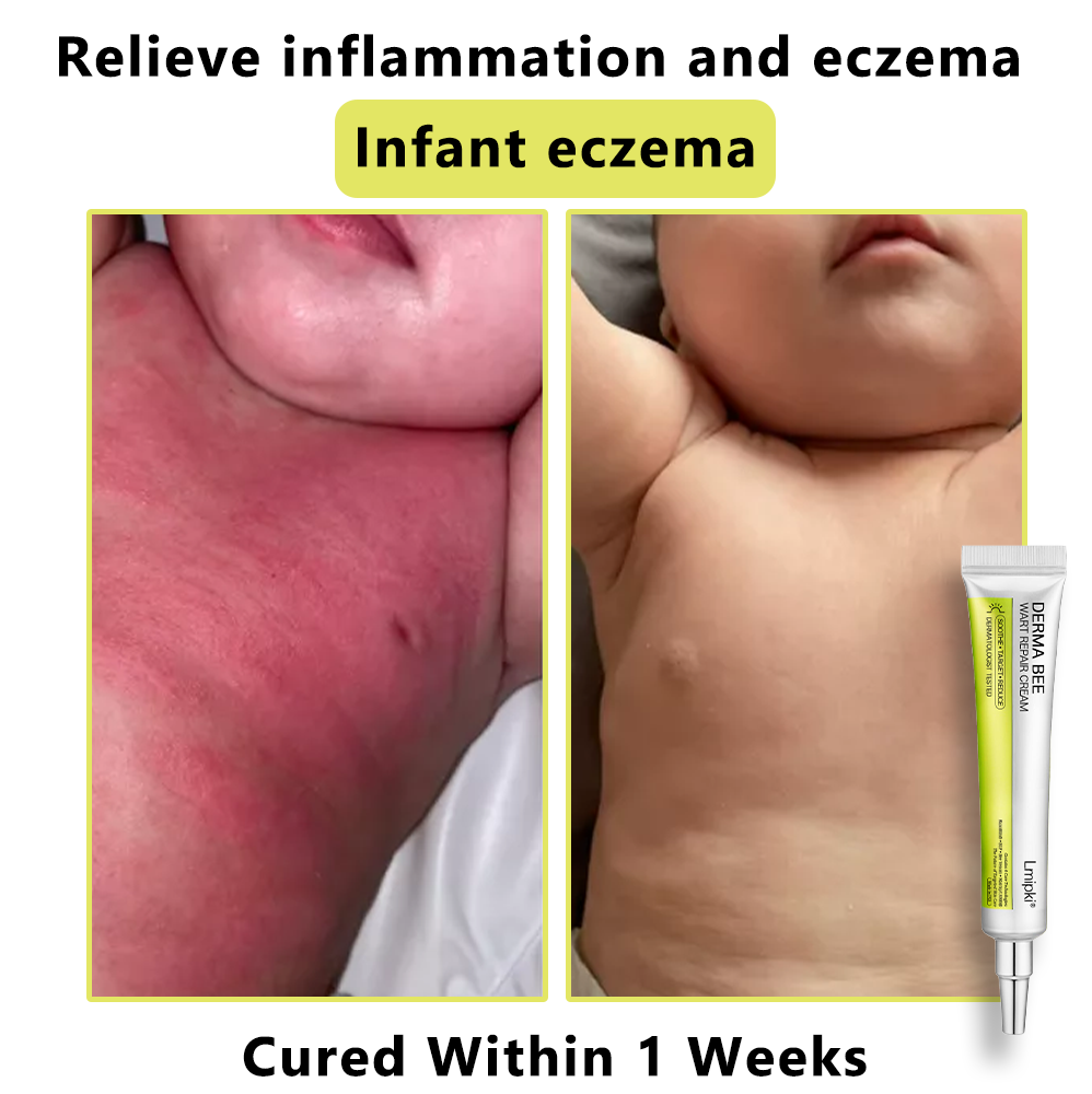 【 𝐿𝑚𝑖𝑝𝑘𝑖®Official Store✅】𝙇𝙢𝑖𝑝𝙠𝙞® Derma  Repair Cream (𝗔𝗽𝗽𝗹𝘆 𝘁𝘄𝗶𝗰𝗲 𝗱𝗮𝗶𝗹𝘆, 𝘄𝗮𝗿𝘁-𝗳𝗿𝗲𝗲 𝗿𝗲𝘀𝘂𝗹𝘁𝘀 𝗶𝗻 𝟮–𝟯 𝘄𝗲𝗲𝗸𝘀) ✅ 𝐅𝐨𝐫 𝒔𝒌𝒊𝒏 𝒕𝒂𝒈, 𝒘𝒓𝒊𝒏𝒌𝒍𝒆𝒔, 𝒗𝒊𝒕𝒊𝒍𝒊𝒈𝒐, 𝒓𝒐𝒔𝒂𝒄𝒆𝒔, 𝒆𝒄𝒛𝒎𝒂, 𝒖𝒓𝒕𝒊𝒄𝒂𝒓𝒊𝒂, 𝒅𝒓𝒚 𝒂𝒏𝒅 𝒇𝒍𝒂𝒌𝒚, 𝐚𝐧𝐝 𝐦𝐨𝐫𝐞