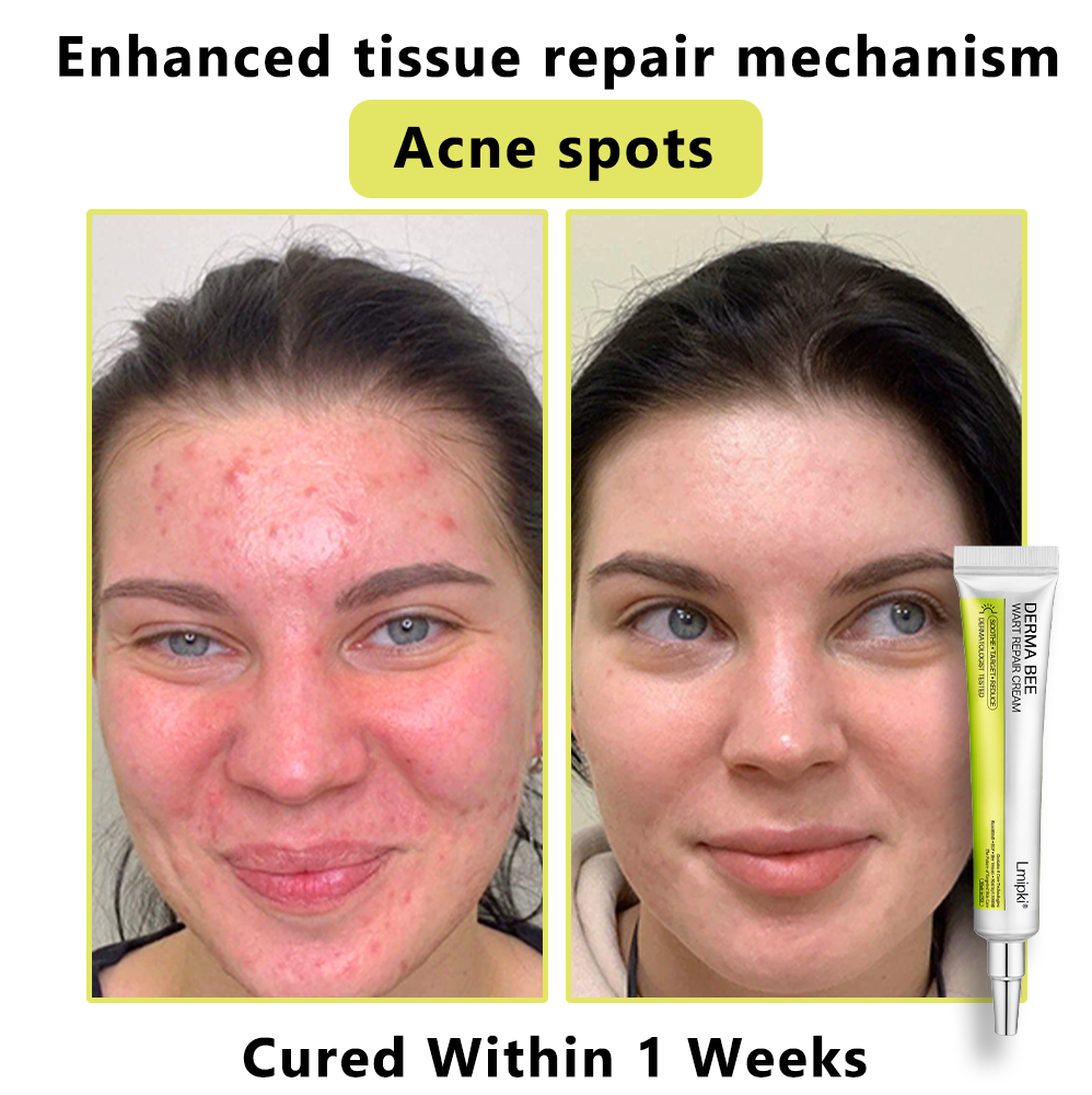 【 𝐿𝑚𝑖𝑝𝑘𝑖®Official Store✅】𝙇𝙢𝑖𝑝𝙠𝙞® Derma  Repair Cream (𝗔𝗽𝗽𝗹𝘆 𝘁𝘄𝗶𝗰𝗲 𝗱𝗮𝗶𝗹𝘆, 𝘄𝗮𝗿𝘁-𝗳𝗿𝗲𝗲 𝗿𝗲𝘀𝘂𝗹𝘁𝘀 𝗶𝗻 𝟮–𝟯 𝘄𝗲𝗲𝗸𝘀) ✅ 𝐅𝐨𝐫 𝒔𝒌𝒊𝒏 𝒕𝒂𝒈, 𝒘𝒓𝒊𝒏𝒌𝒍𝒆𝒔, 𝒗𝒊𝒕𝒊𝒍𝒊𝒈𝒐, 𝒓𝒐𝒔𝒂𝒄𝒆𝒔, 𝒆𝒄𝒛𝒎𝒂, 𝒖𝒓𝒕𝒊𝒄𝒂𝒓𝒊𝒂, 𝒅𝒓𝒚 𝒂𝒏𝒅 𝒇𝒍𝒂𝒌𝒚, 𝐚𝐧𝐝 𝐦𝐨𝐫𝐞