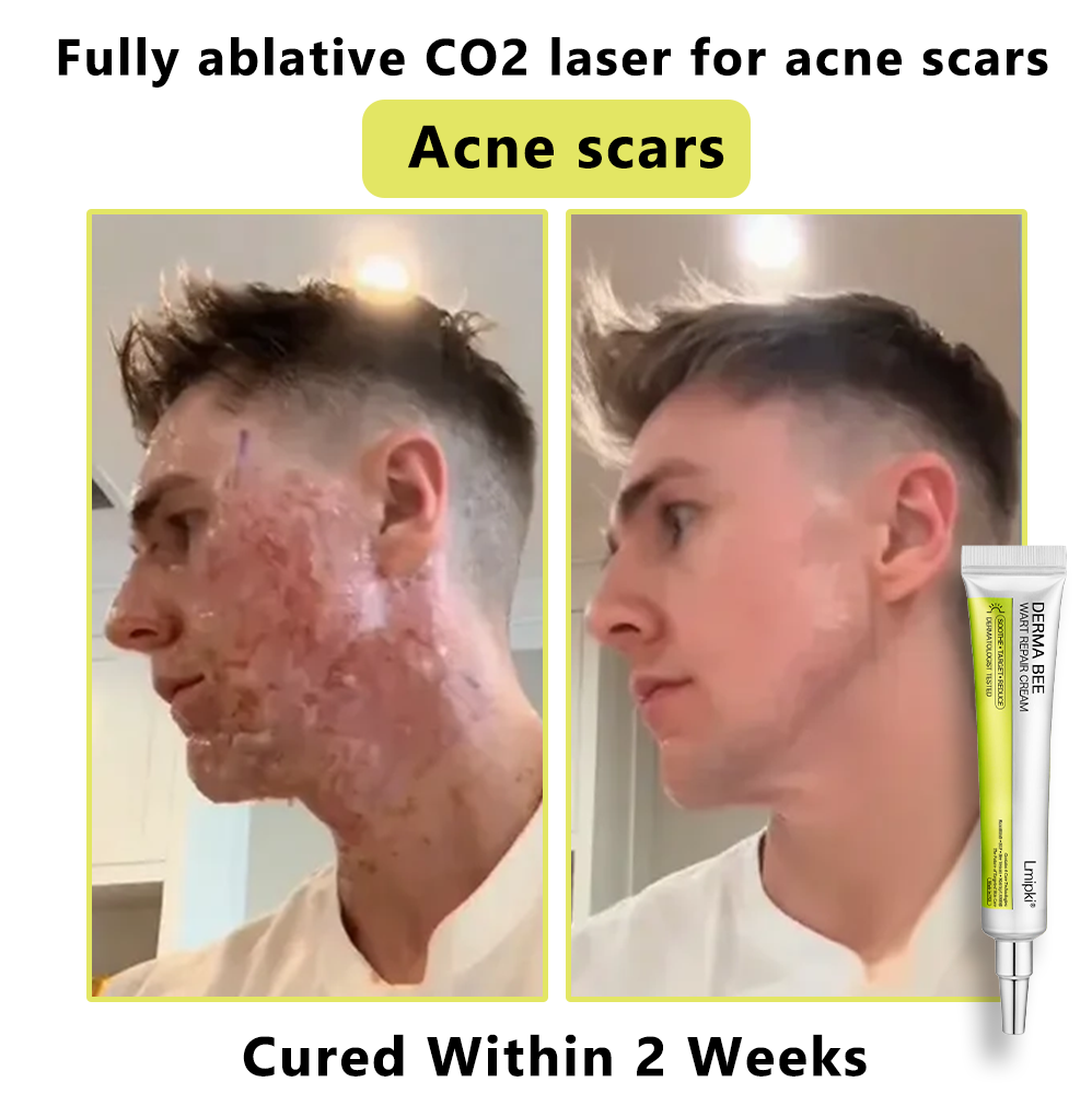 【 𝐿𝑚𝑖𝑝𝑘𝑖®Official Store✅】𝙇𝙢𝑖𝑝𝙠𝙞® Derma  Repair Cream (𝗔𝗽𝗽𝗹𝘆 𝘁𝘄𝗶𝗰𝗲 𝗱𝗮𝗶𝗹𝘆, 𝘄𝗮𝗿𝘁-𝗳𝗿𝗲𝗲 𝗿𝗲𝘀𝘂𝗹𝘁𝘀 𝗶𝗻 𝟮–𝟯 𝘄𝗲𝗲𝗸𝘀) ✅ 𝐅𝐨𝐫 𝒔𝒌𝒊𝒏 𝒕𝒂𝒈, 𝒘𝒓𝒊𝒏𝒌𝒍𝒆𝒔, 𝒗𝒊𝒕𝒊𝒍𝒊𝒈𝒐, 𝒓𝒐𝒔𝒂𝒄𝒆𝒔, 𝒆𝒄𝒛𝒎𝒂, 𝒖𝒓𝒕𝒊𝒄𝒂𝒓𝒊𝒂, 𝒅𝒓𝒚 𝒂𝒏𝒅 𝒇𝒍𝒂𝒌𝒚, 𝐚𝐧𝐝 𝐦𝐨𝐫𝐞