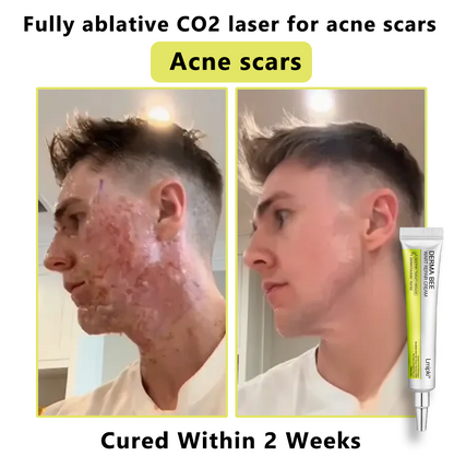 【 𝐿𝑚𝑖𝑝𝑘𝑖®Official Store✅】𝙇𝙢𝑖𝑝𝙠𝙞® Derma  Repair Cream (𝗔𝗽𝗽𝗹𝘆 𝘁𝘄𝗶𝗰𝗲 𝗱𝗮𝗶𝗹𝘆, 𝘄𝗮𝗿𝘁-𝗳𝗿𝗲𝗲 𝗿𝗲𝘀𝘂𝗹𝘁𝘀 𝗶𝗻 𝟮–𝟯 𝘄𝗲𝗲𝗸𝘀) ✅ 𝐅𝐨𝐫 𝒔𝒌𝒊𝒏 𝒕𝒂𝒈, 𝒘𝒓𝒊𝒏𝒌𝒍𝒆𝒔, 𝒗𝒊𝒕𝒊𝒍𝒊𝒈𝒐, 𝒓𝒐𝒔𝒂𝒄𝒆𝒔, 𝒆𝒄𝒛𝒎𝒂, 𝒖𝒓𝒕𝒊𝒄𝒂𝒓𝒊𝒂, 𝒅𝒓𝒚 𝒂𝒏𝒅 𝒇𝒍𝒂𝒌𝒚, 𝐚𝐧𝐝 𝐦𝐨𝐫𝐞
