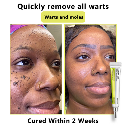 【 𝐿𝑚𝑖𝑝𝑘𝑖®Official Store✅】𝙇𝙢𝑖𝑝𝙠𝙞® Derma  Repair Cream (𝗔𝗽𝗽𝗹𝘆 𝘁𝘄𝗶𝗰𝗲 𝗱𝗮𝗶𝗹𝘆, 𝘄𝗮𝗿𝘁-𝗳𝗿𝗲𝗲 𝗿𝗲𝘀𝘂𝗹𝘁𝘀 𝗶𝗻 𝟮–𝟯 𝘄𝗲𝗲𝗸𝘀) ✅ 𝐅𝐨𝐫 𝒔𝒌𝒊𝒏 𝒕𝒂𝒈, 𝒘𝒓𝒊𝒏𝒌𝒍𝒆𝒔, 𝒗𝒊𝒕𝒊𝒍𝒊𝒈𝒐, 𝒓𝒐𝒔𝒂𝒄𝒆𝒔, 𝒆𝒄𝒛𝒎𝒂, 𝒖𝒓𝒕𝒊𝒄𝒂𝒓𝒊𝒂, 𝒅𝒓𝒚 𝒂𝒏𝒅 𝒇𝒍𝒂𝒌𝒚, 𝐚𝐧𝐝 𝐦𝐨𝐫𝐞
